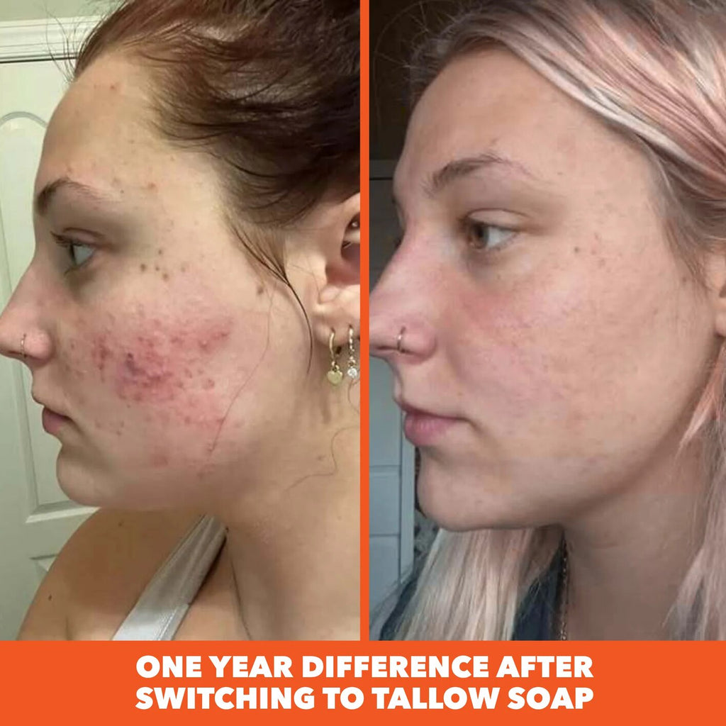 One year difference after switching to tallow soap